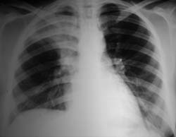 I polmoni affetti da Tbc